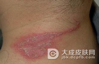 神经性皮炎的护理方法都有哪些