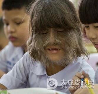多毛症的病因有哪些方面呢