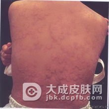 关于荨麻疹型药疹的症状