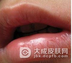关于剥脱性唇炎的症状及临床表现