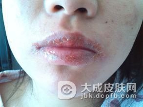 剥脱性唇炎日常饮食和行为习惯介绍