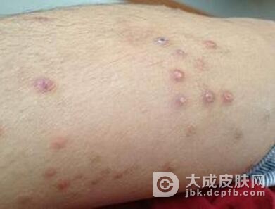 疱疹样皮炎的发生症状介绍