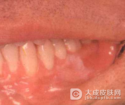 黏膜白斑的治疗措施