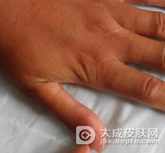 局限性硬皮病有什么症状呢