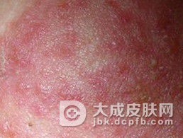 关节型银屑病主要表现