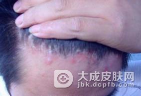 关节型银屑病潜在的危害有哪些？