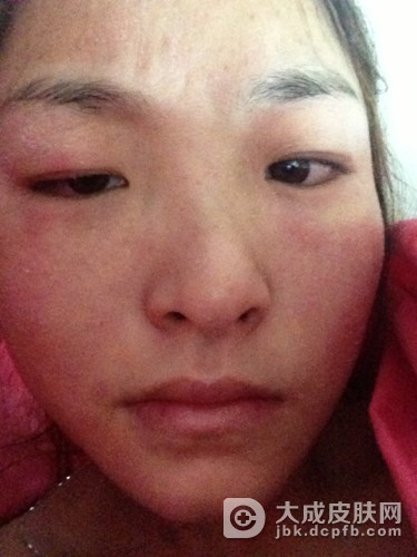 哪些食物会引起皮肤过敏