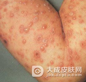 哪个年龄段最容易出现水痘？