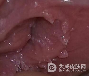 如何判断女性尖锐湿疣