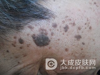 老年斑怎么样的去除