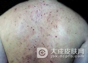 淤滞性皮炎症状特点有什么