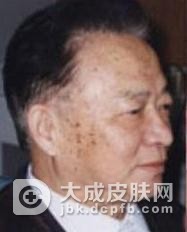 老年斑会传染吗