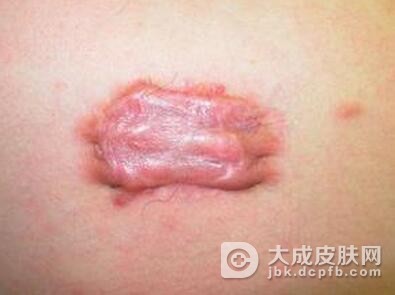 如何预防疤痕的发生的呢
