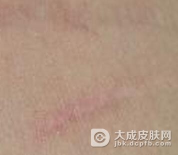 疤痕的临床危害有哪些呢