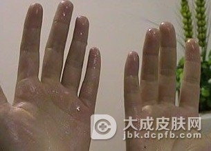 多汗症带来的危害都有哪些