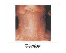 哪些食物可影响寻常狼疮