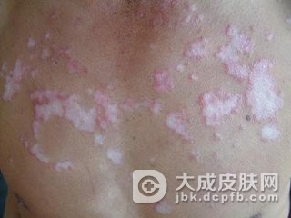 寻常狼疮的并发疾病有什么