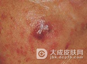 寻常狼疮的治疗原则