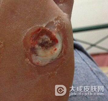 鸡眼有什么预防措施呢