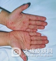 手足口病与哪些疾病鉴别