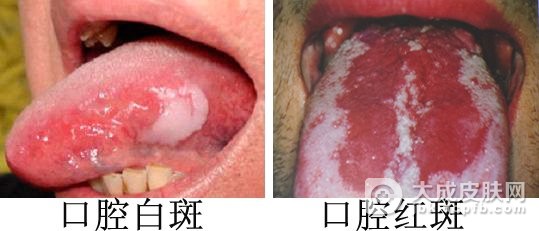 口腔白斑是什么的原因引起的