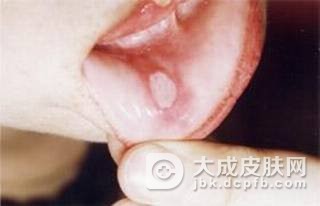 口腔白斑是哪些的原因引起的
