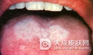 口腔白斑的皮损表现是什么