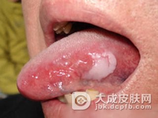 口腔白斑病有哪几种类型