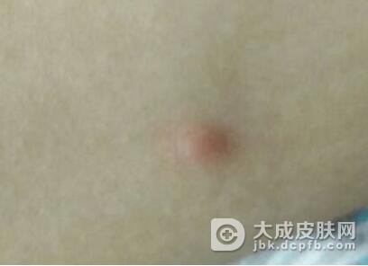 一期梅毒的诊断依据是什么