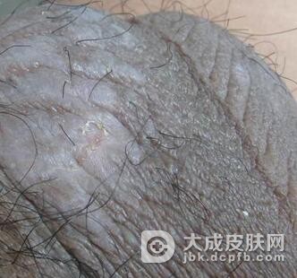 介绍治疗阴囊湿疹方法