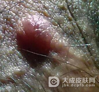 为什么一期梅毒不容易发现