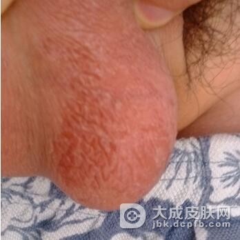 阴囊湿疹怎么办才好呢