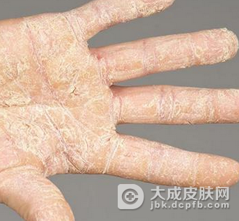 怎么会得副银屑病