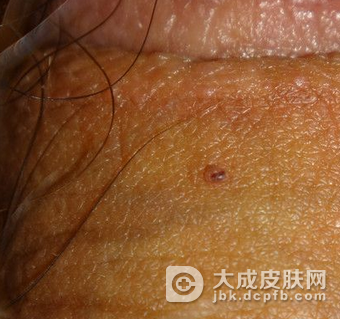 尖锐湿疣传染给男性是通过什么途径