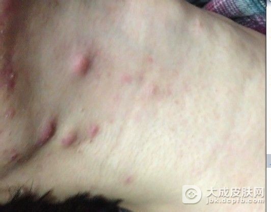 梅毒的发病原因有哪些呢？