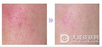 怎样的预防脸部的红血丝