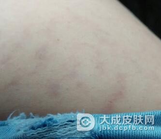 萎缩纹的症状表现是什么