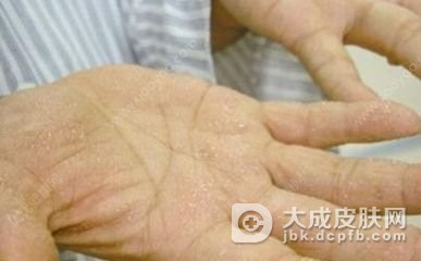 多汗症症状特点的讲解