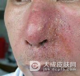 预防酒渣鼻有哪些方法呢