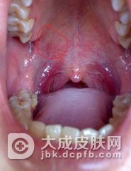 口腔白斑病如何做出诊断