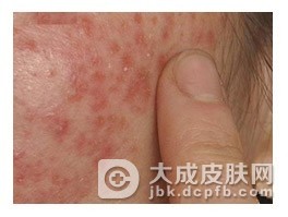 传染性红斑的预防