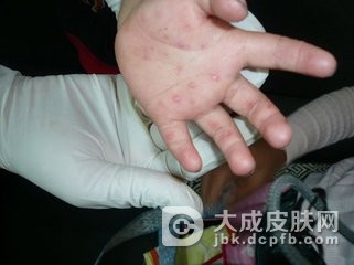 通过看口腔判断手足口病