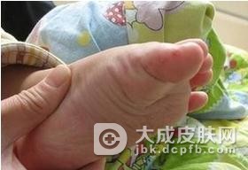 手足口病是怎么样传播的