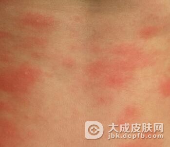 季节性皮肤过敏怎么回事