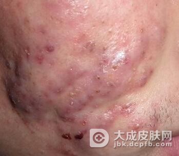 痤疮皮肤要怎样进行护理