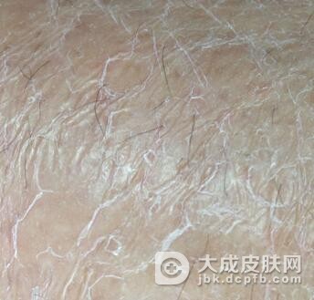 正确认识什么是鱼鳞病