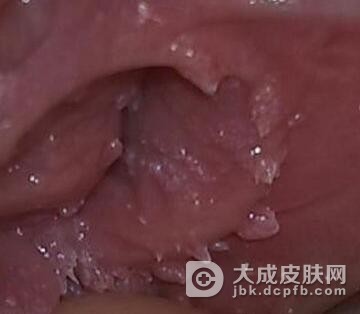 女性尖锐湿疣是什么样的