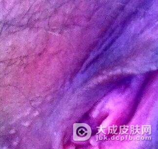 女性尖锐湿疣的初期症状有什么