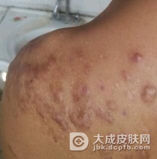 外伤疤痕预防要注意什么
