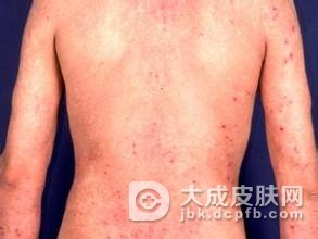 预防接触性皮炎该怎么做呢
